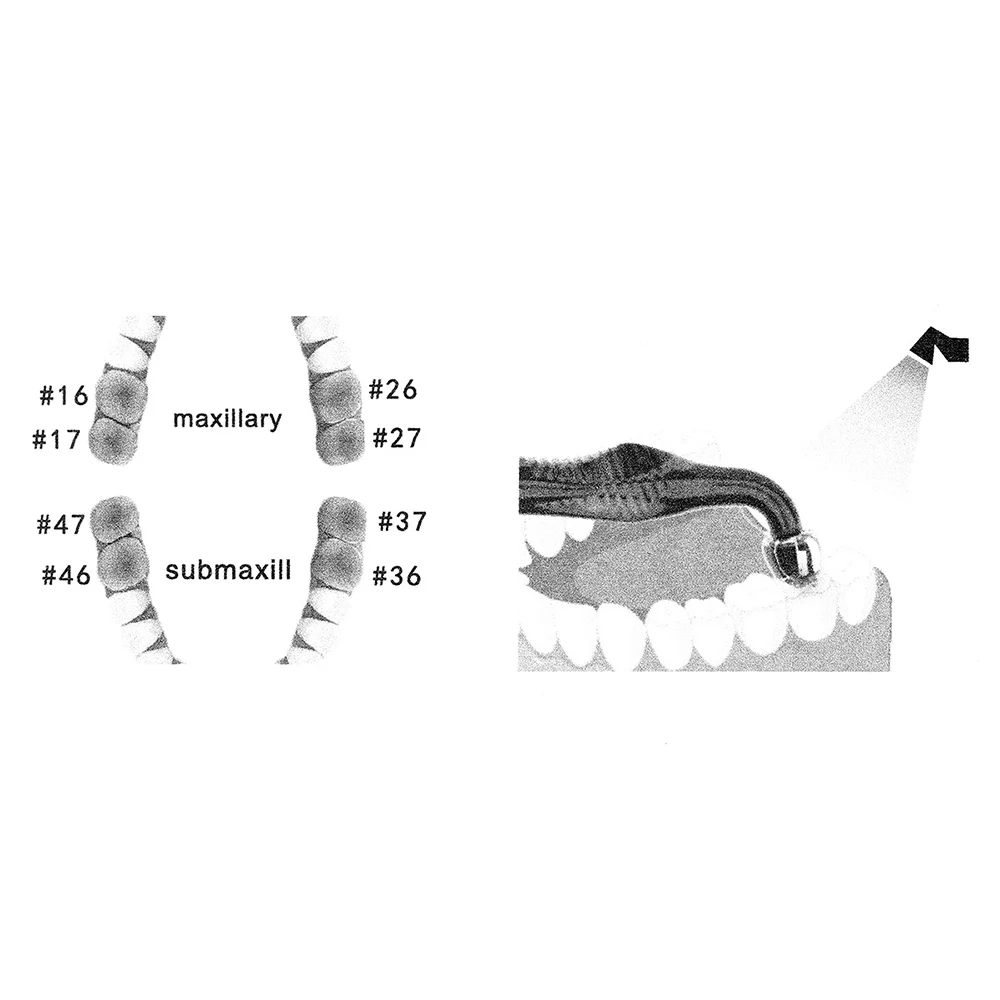 Dental Orthodontic Posterior T - огляд і ціна 3D Printing Orthodontics